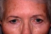 Patient 2