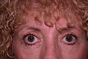 Patient 3
